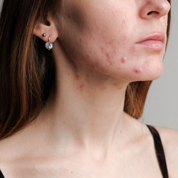 Hormonal acne in estrogen dominance