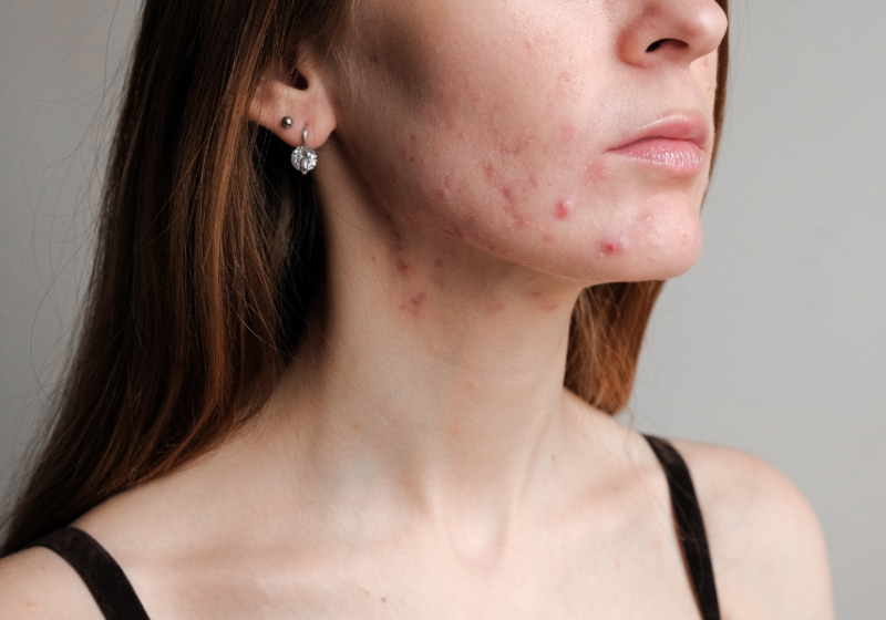 Hormonal acne in estrogen dominance