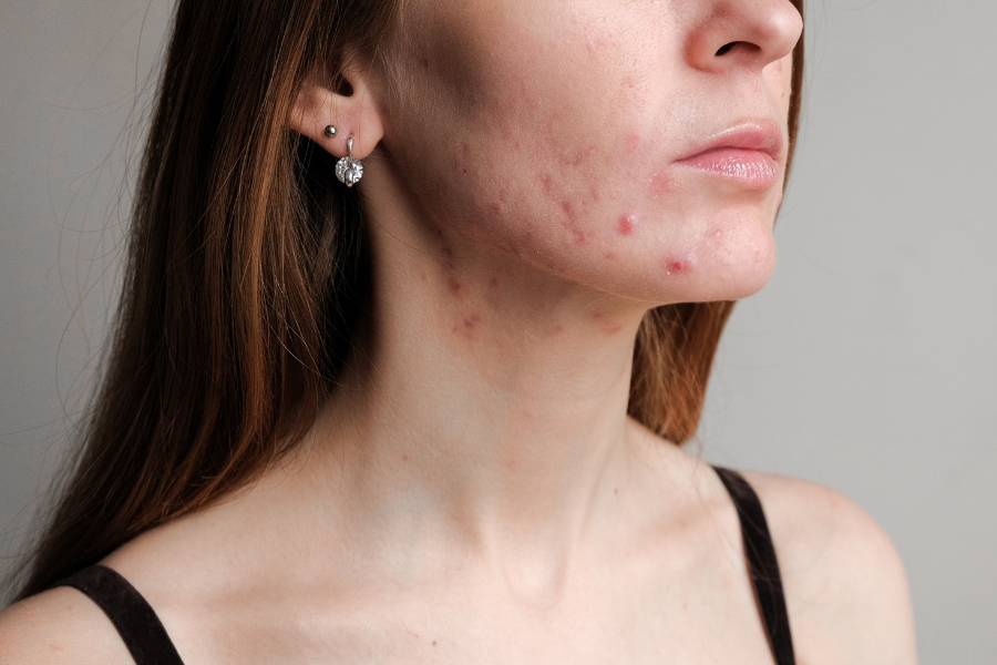 Hormonal acne in estrogen dominance